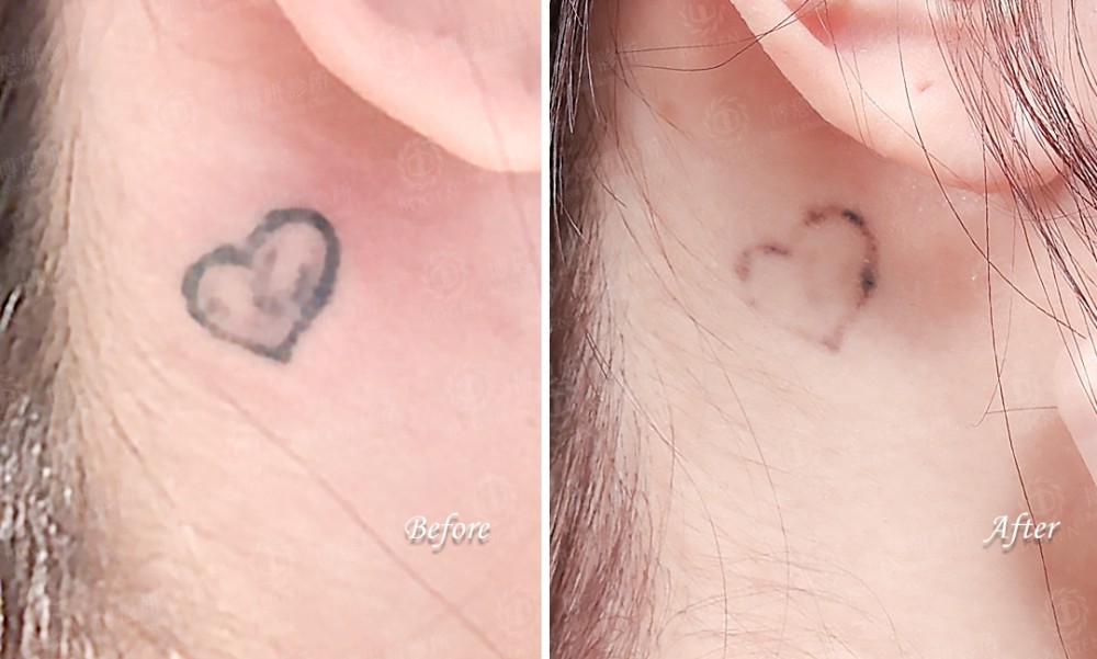 皮秒雷射除刺青,皮秒除刺青,除刺青,博恩妍